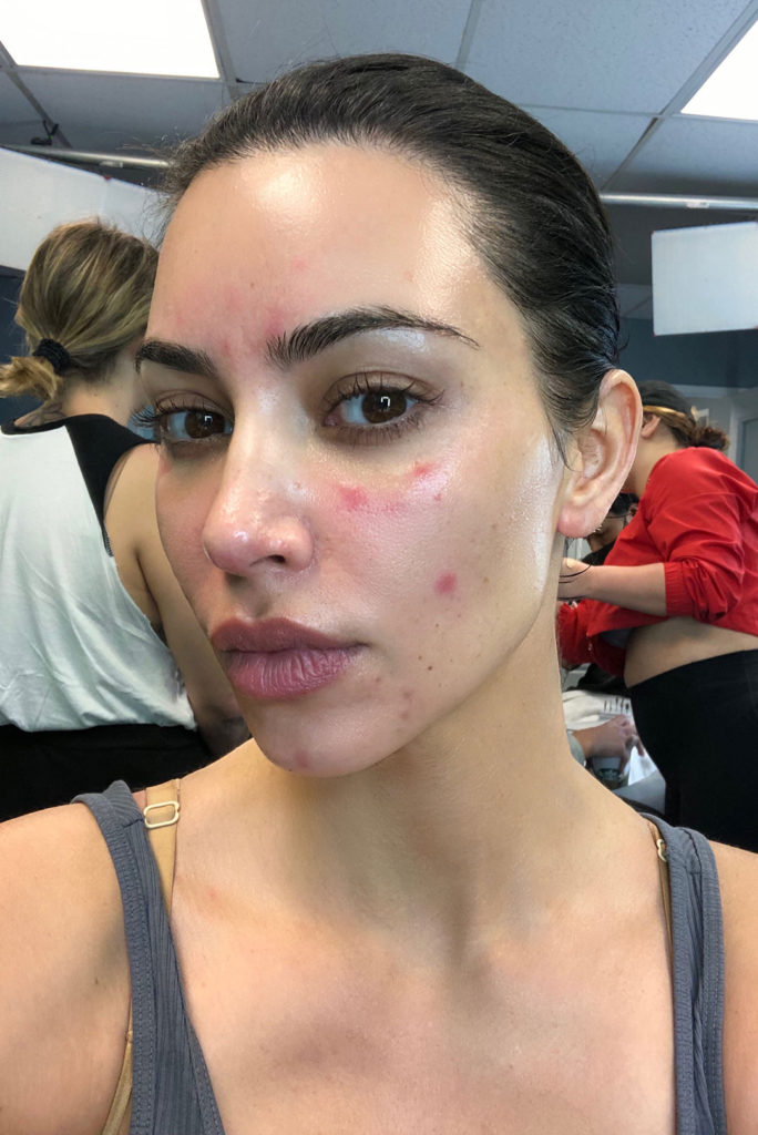 Kim Kardashian Opens Up about Her Struggle with Psoriasis